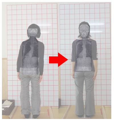 側弯症2.png